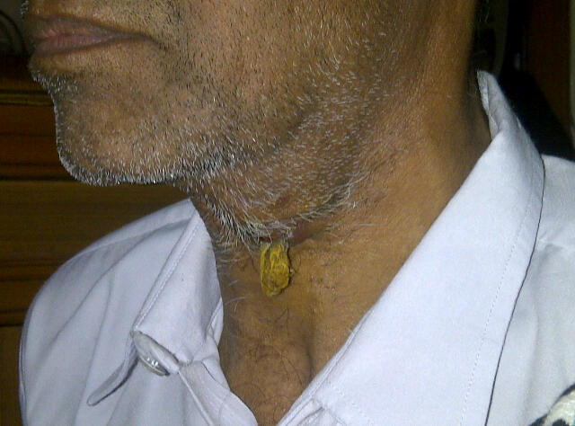1. Mr Taraknath ... tumour on the neck